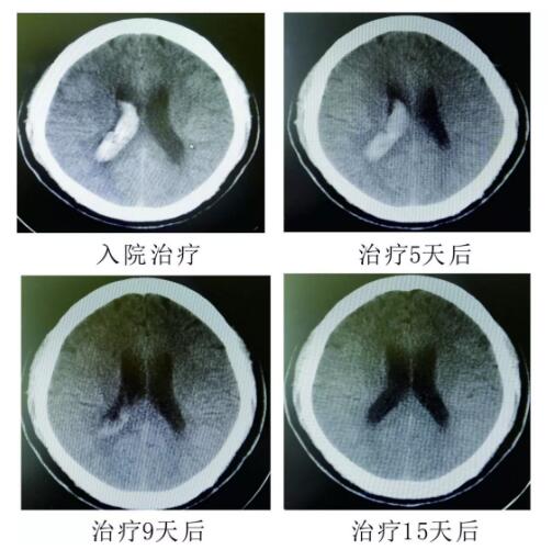 腦出血你不得不引起重視的疾病！??！