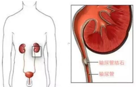 輸尿管結(jié)石，到底能不能保守治療？