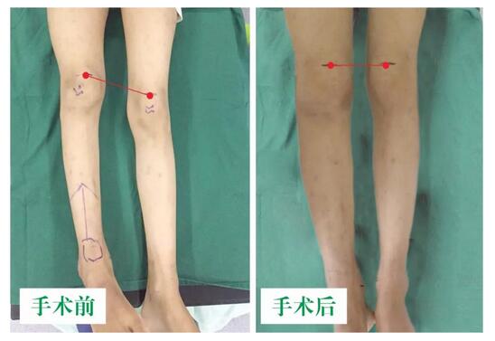 女孩墜梯右腿縮短5cm，幸得醫(yī)生及時診治恢復正常腿型