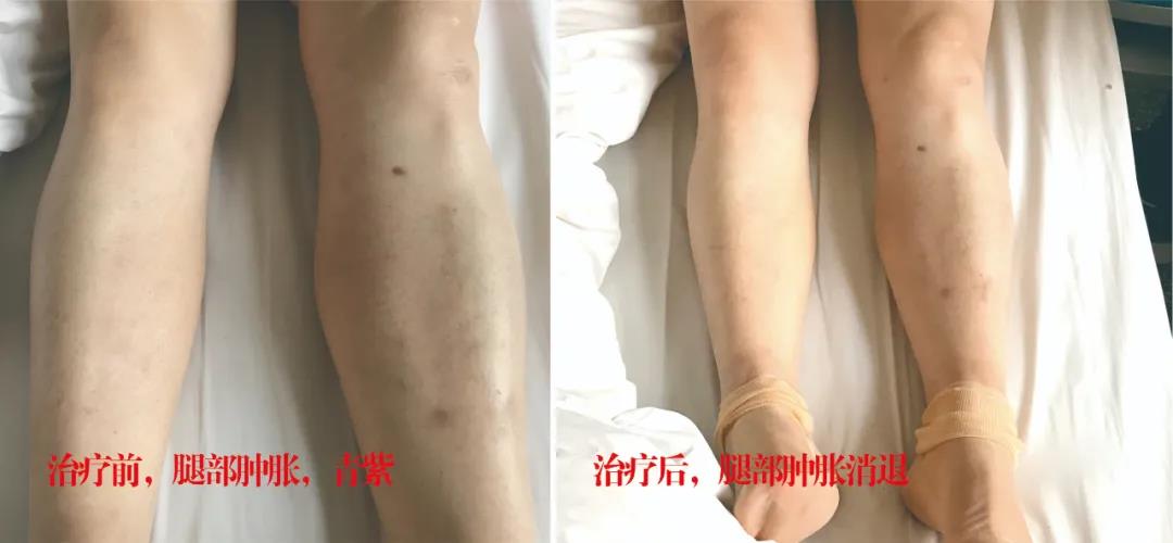 下肢靜脈血栓多年頑疾反復(fù)腫痛——疾病不容等待，早治療，早健康！