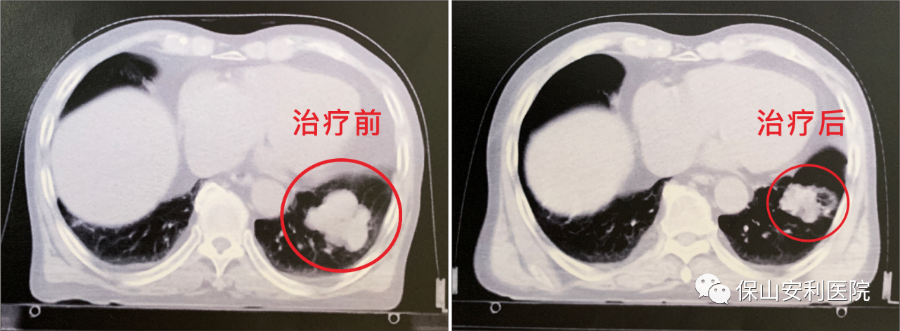 不做手術(shù)，早期肺癌也能根治！